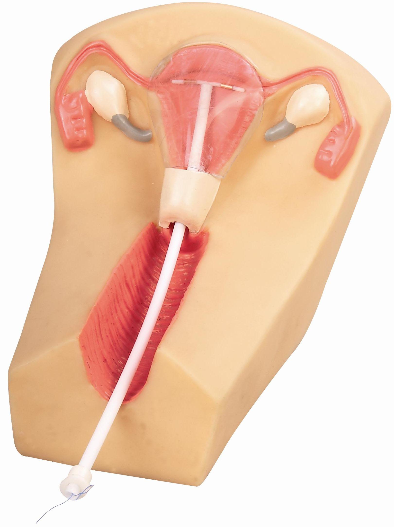 子宫环置于子宫内(必须由 a target="_blank" href="/item/医生/938