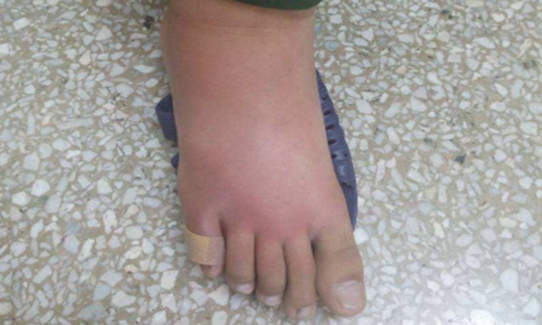 其临床特点是全足背高肿掀红疼痛,足心不肿.