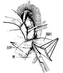 data-lemmaid="957242">食管癌 /a>切除术是用于治疗食管癌的手术方法