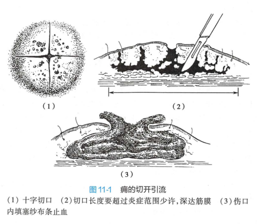 痈（皮肤病）_百度百科