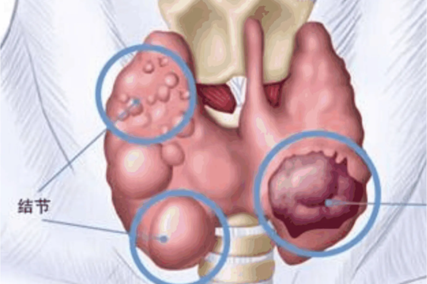 结节