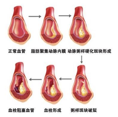 血栓_百度百科