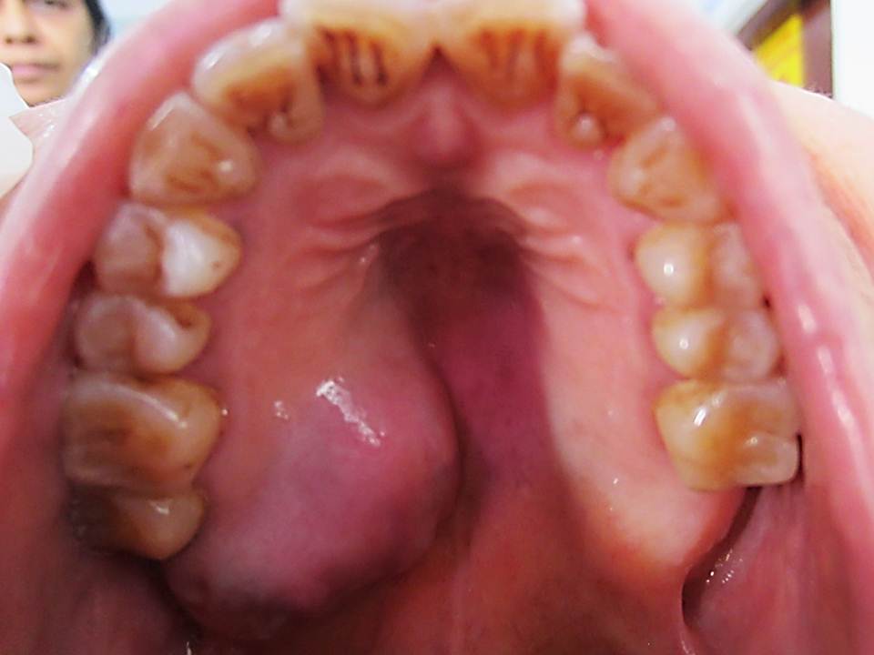  p>软腭:腭(口腔的上膛)的后部,由结缔组织和肌肉构成.