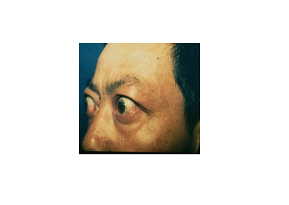 和浸润性两种,非 a target="_blank" href="/item/浸润性突眼/126502