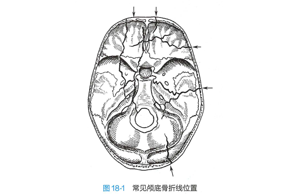 颅底骨折