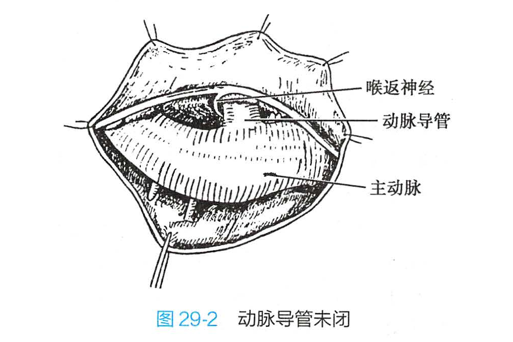 动脉导管未闭