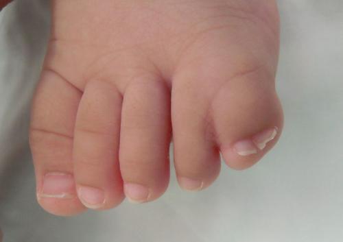  p>并趾是指五趾之间的两只或是两只以上,互相粘连在一起没有独立分开