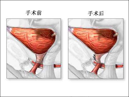 壁 /a>脱垂常伴有 a target="_blank" href="/item/膀胱膨出/1577733"