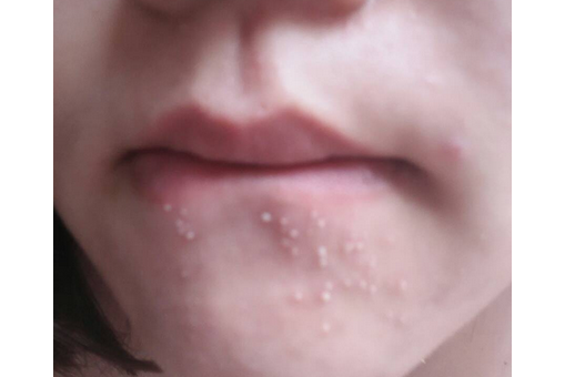  p>唇边痘是指在嘴唇的周围所起的痘痘,唇边长痘跟肠道有直接关系,除