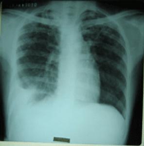 急性渗出性胸膜炎