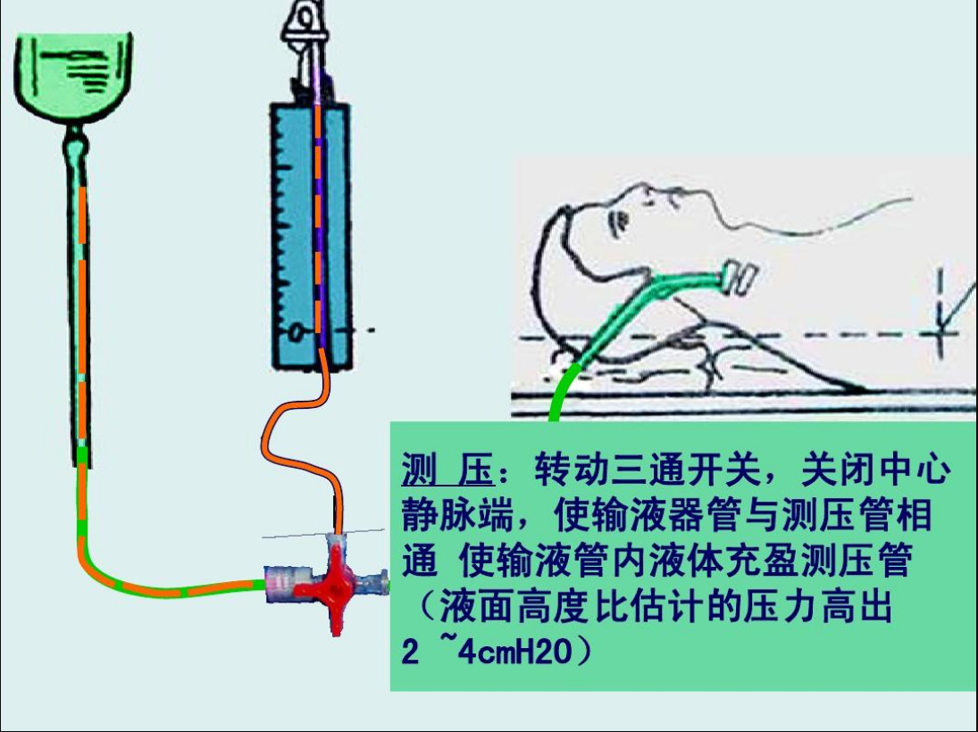  p>中心静脉压(central venous pressure,cvp)是指右心房及上,下腔