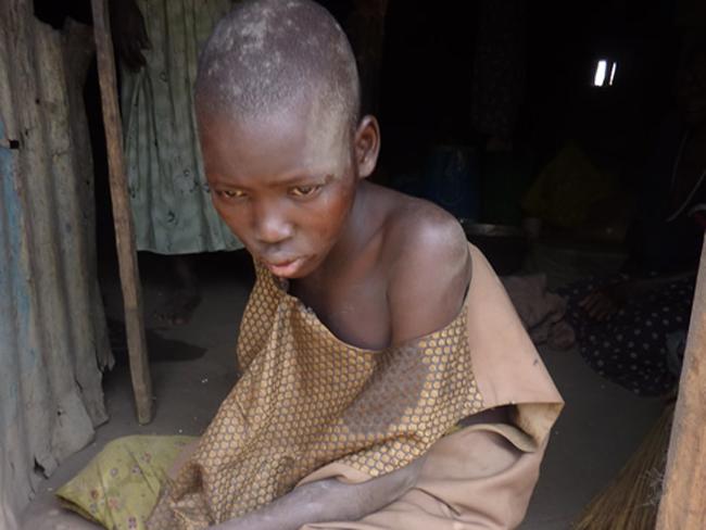  p>"点头病"(nodding disease),这种 a target="_blank" href="/item