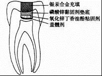  p data-id="gnvidt3b83">盖髓术 i>(pulp capping) /i>,是一种保护活