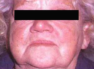 粘液性水肿面容是 a href="#" data-lemmaid="1329819">甲状腺机能