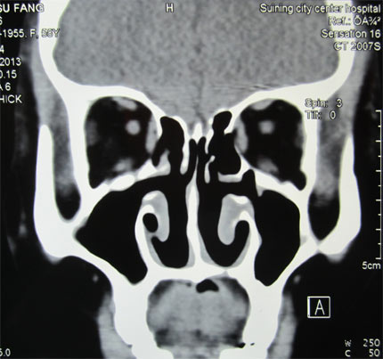 又名臭鼻症的手术;surgery of rhinitis atrophicans,是一种耳鼻喉科