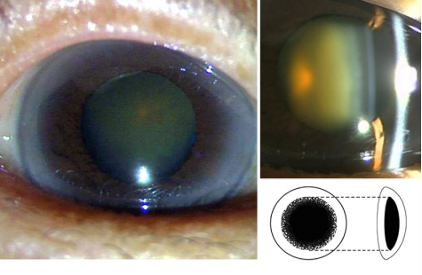 层皮质出现棕黄色浑浊,为许多致密小点组成,其中有小空泡和结晶样颗粒