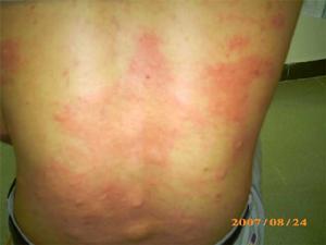  p>钩蚴皮炎(hookwormdiseases)是由钩蚴(hookworm)寄生人体小肠所