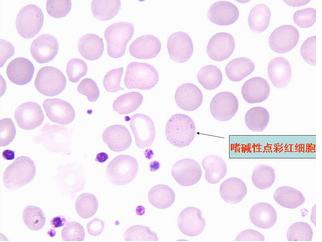 遗传性椭圆形红细胞增多症