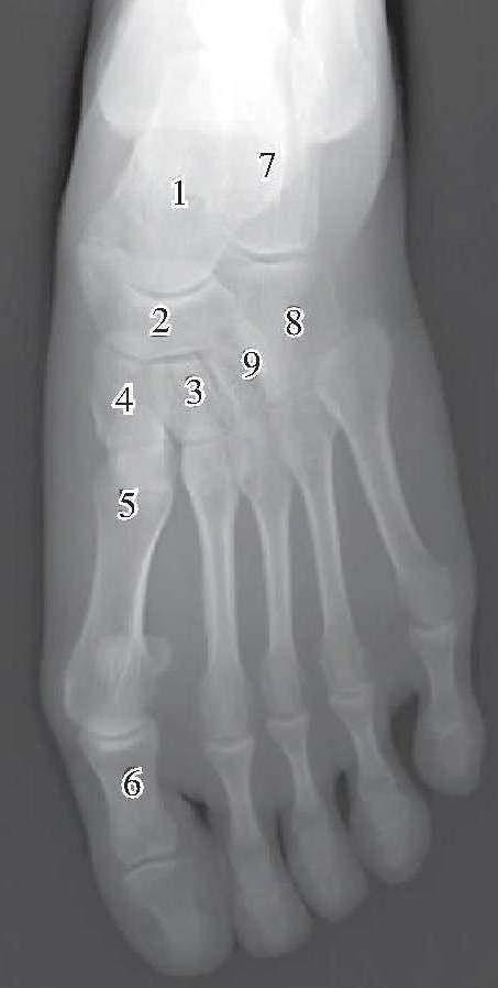  p>跗骨(tarsal bones) 组成足的后半部的短骨,共有7块,即跟骨(cal