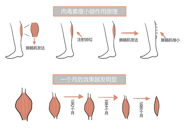  p>肉毒素瘦小腿是临床上最佳瘦腿方法,通过注射的方法来控制肌肉的