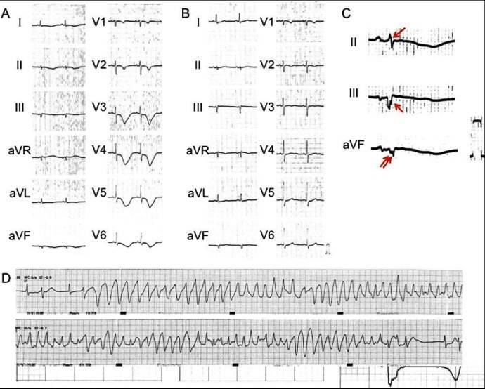 qt间期延长综合症