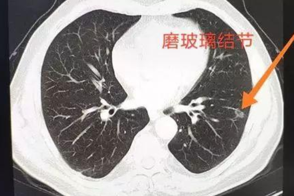 肺部磨玻璃小结节