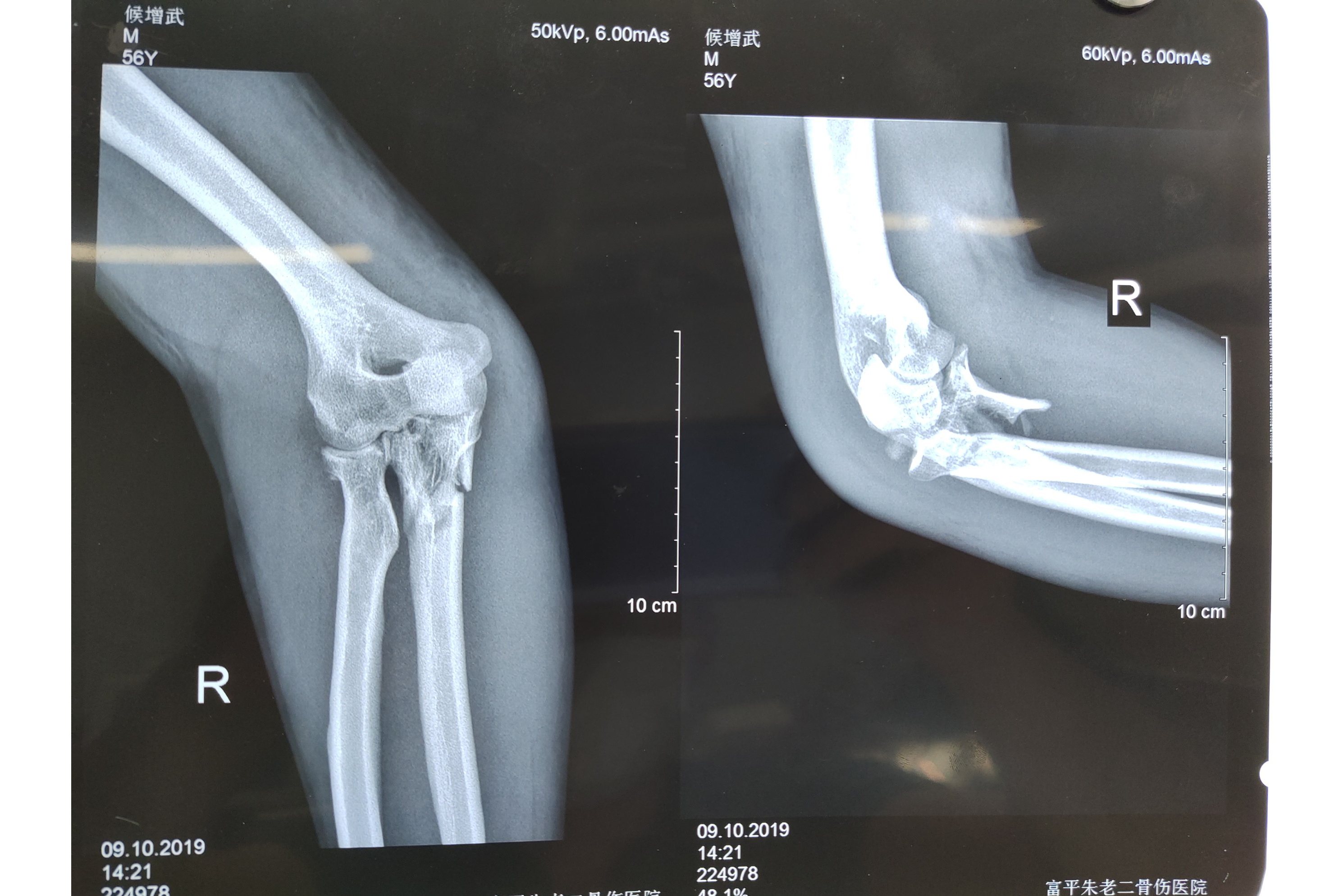 肘关节恐怖三联征