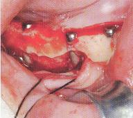  p data-id="2ihdsxouri6">下牙槽神经移位术示暴露下颌管的颊侧骨面
