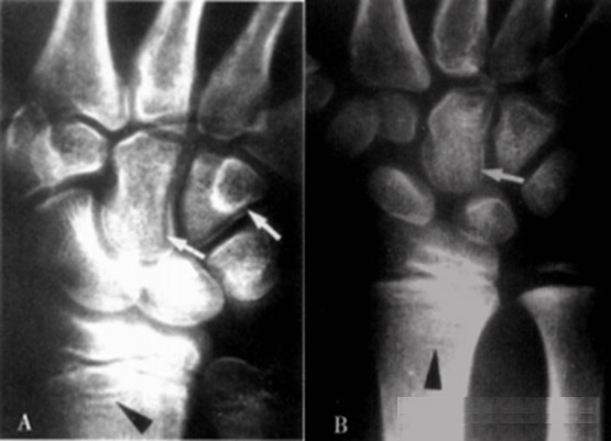 小儿的干骺端生长最活跃,在这里可以看到软骨内化骨的过程.