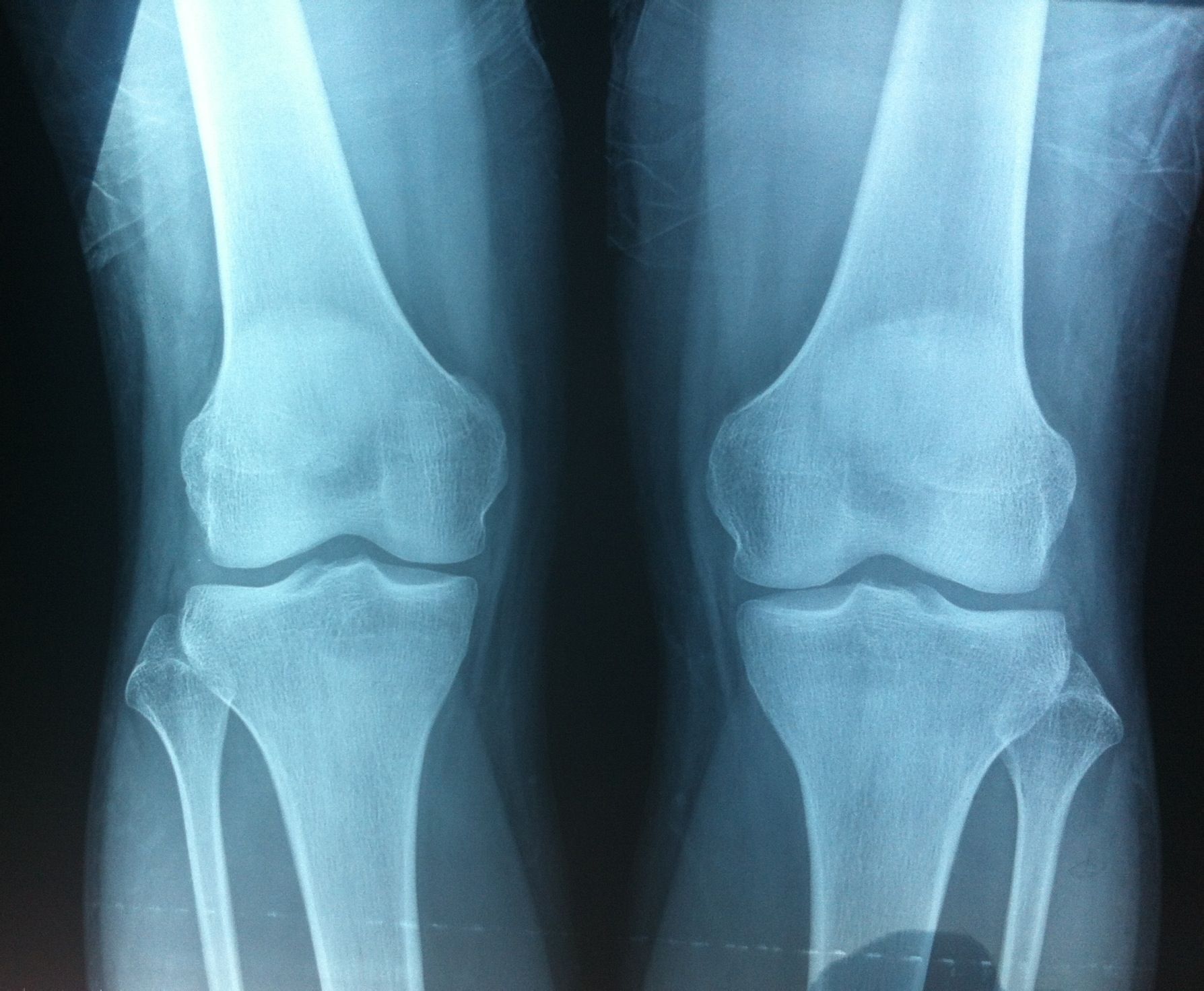 data-lemmaid="3240346">软骨 /a>中出现的骨化点