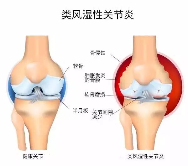 类风湿性关节炎的症状是什么(类风湿性关节炎的症状是什么引起的)