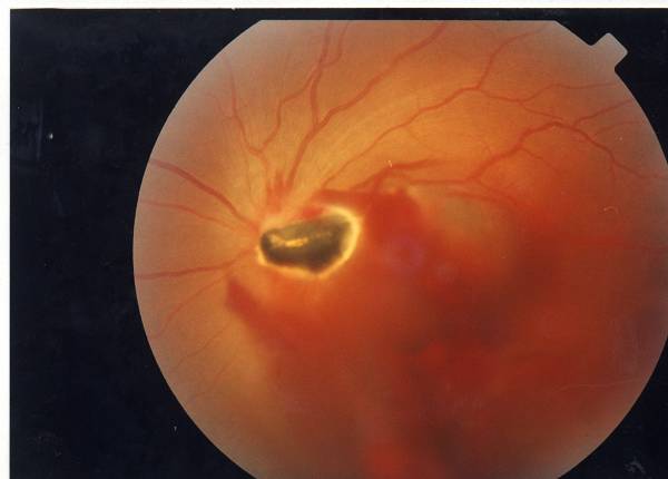  p>外伤性眼内炎是眼损伤后眼球壁的一层或多层膜及相邻眼内腔的炎症