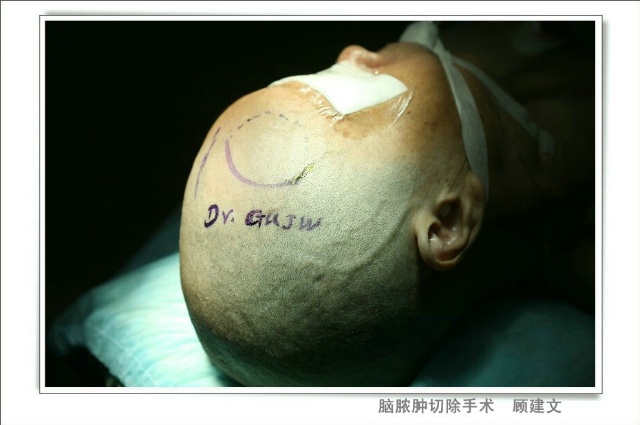  p>额叶切除手术英文为lobotomy.