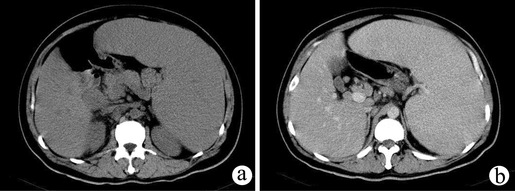 脾肿大 全网资源