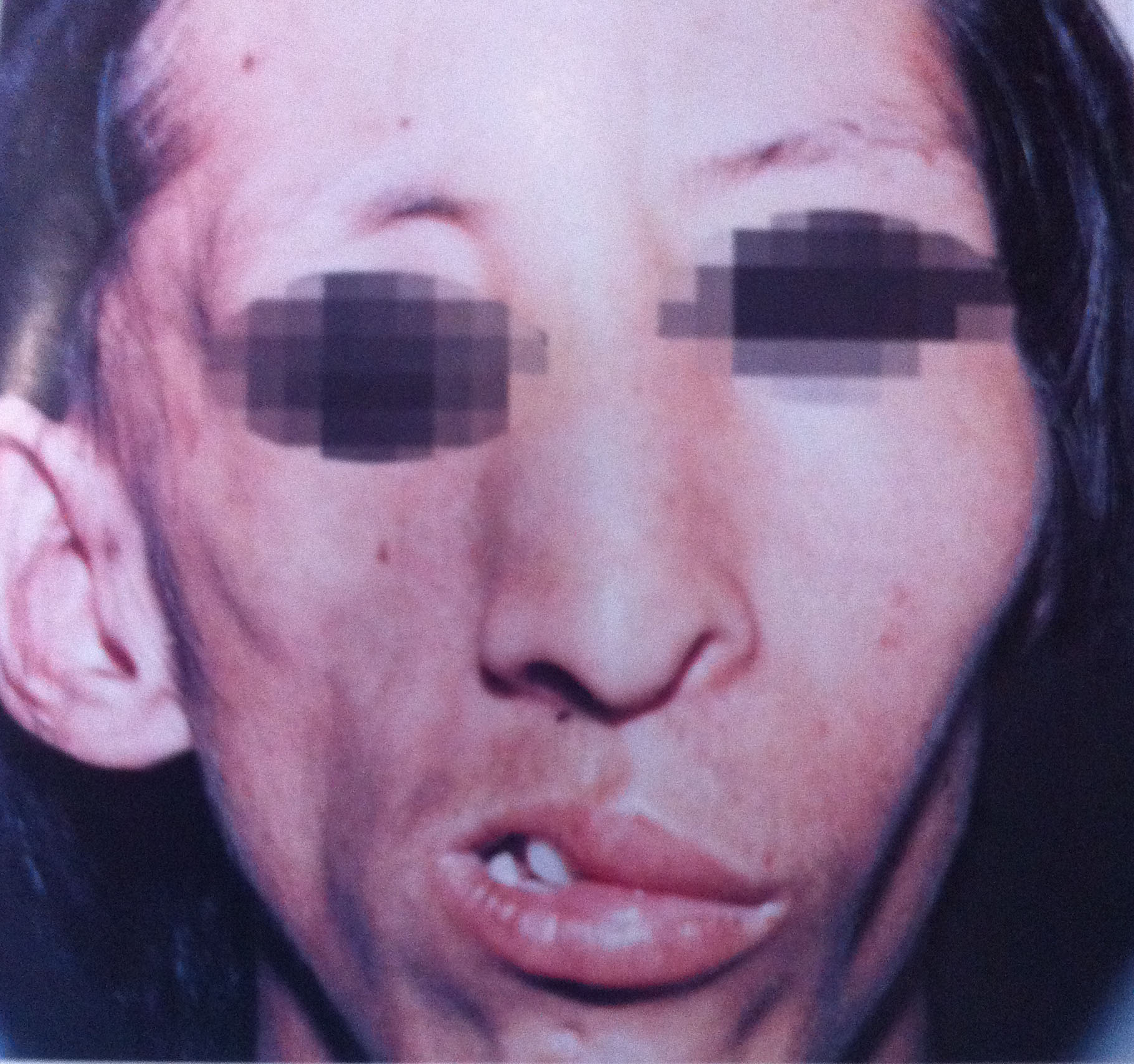 为一种发生在面部一侧进行性萎缩,可波及皮肤,皮下, a target="_blank