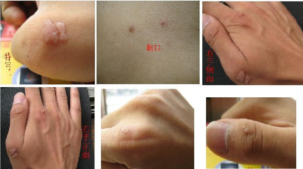  p>鱼痣即鱼鳞痣,究其本质不是一种痣,其实是一种 a target="_blank"