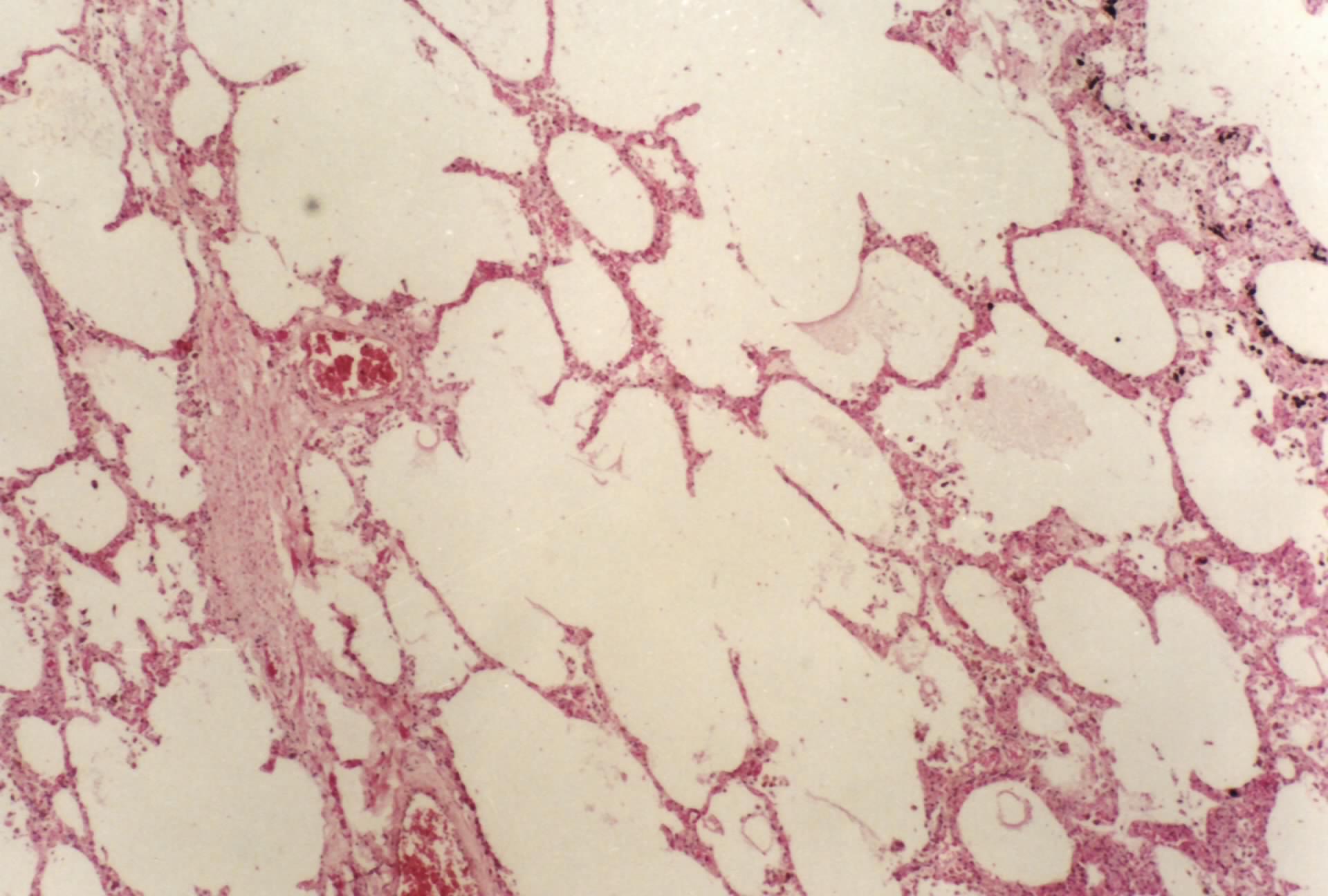 其本质是由多数单元化细胞组成肺泡囊与肺泡管连续,每个