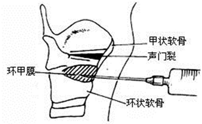 环甲膜穿刺