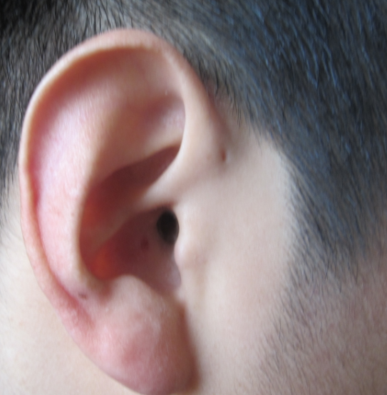 瘘管 /a>是一种常见的 a target="_blank" href="/item/先天性畸形