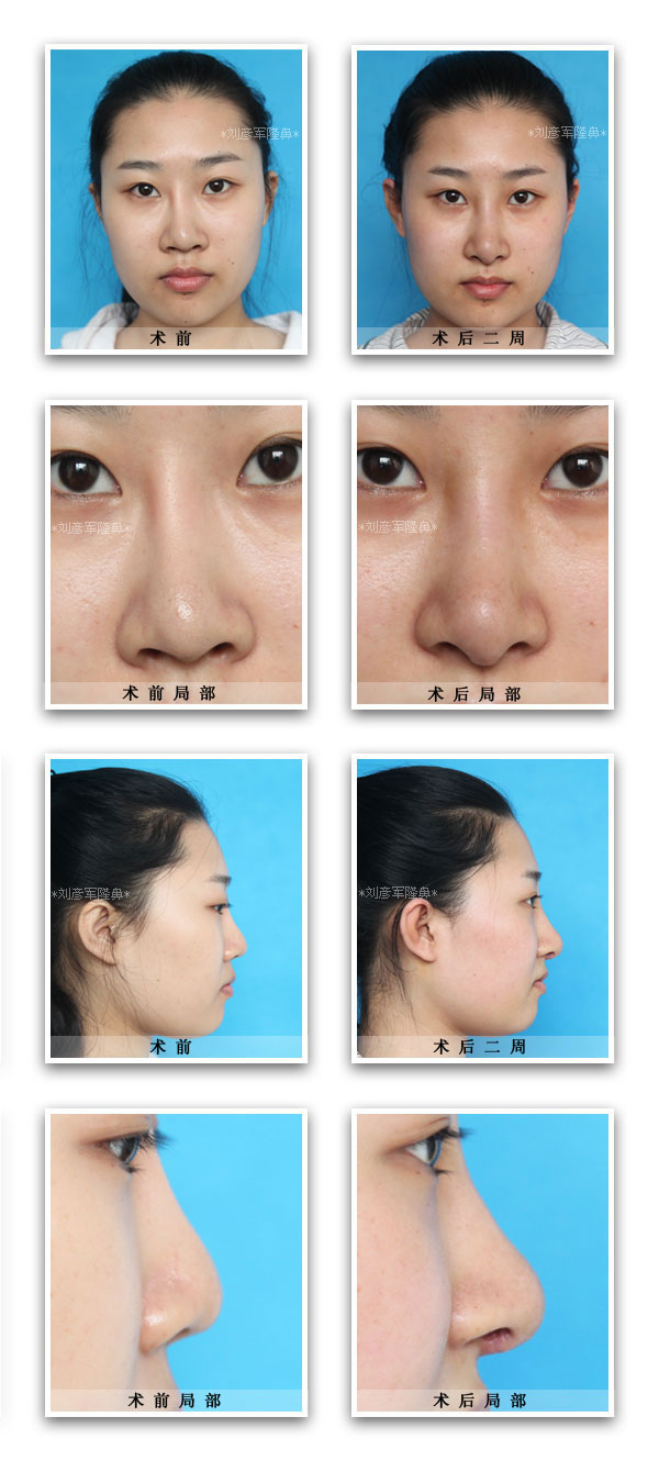  p>膨体隆鼻整形术,是 a href="#" data-lemmaid="1107603">鼻子整形