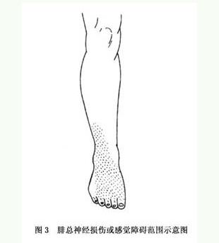 发疹性毳毛囊肿腓总神经卡压症