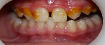 href="#" data-lemmaid="1099155">白垩色 /a>的点或 a href="#" data