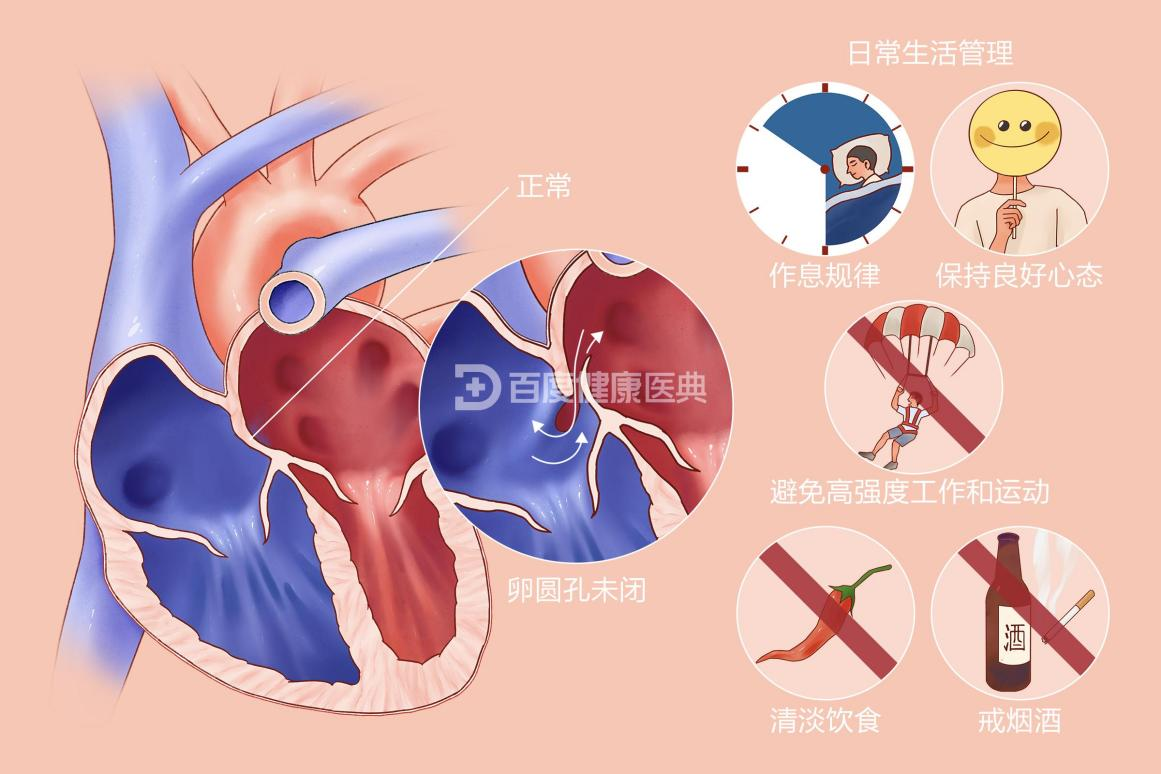 卵圆孔未闭是一种先天性心脏结构异常,是应于婴儿出生后自然闭合的