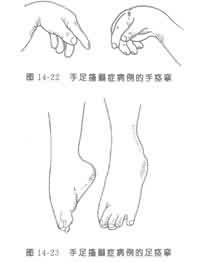 营养性维生素d缺乏性手足抽搐症