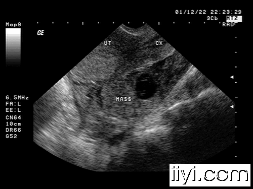 corpus luteum of pregnancy