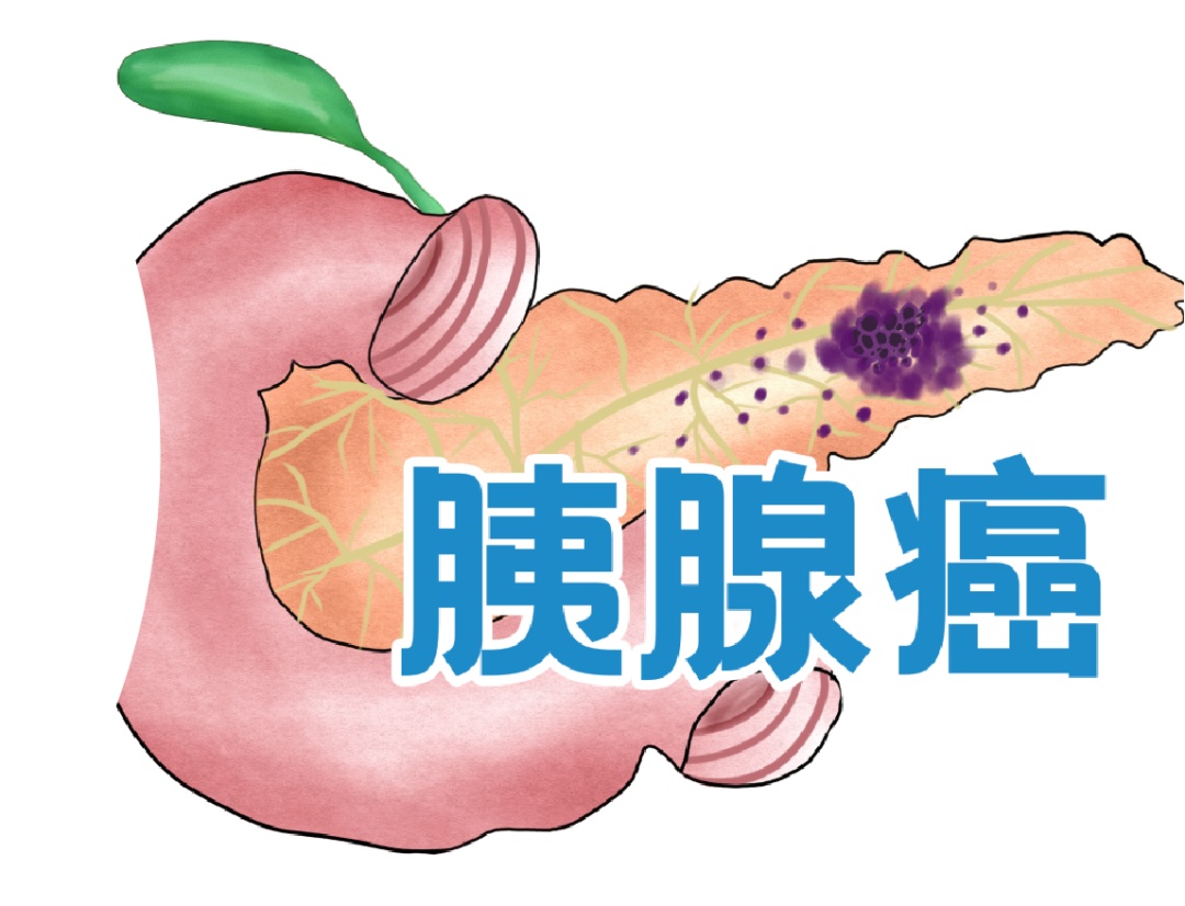 癌中之王“胰腺癌” 真的可怕吗？_百科TA说
