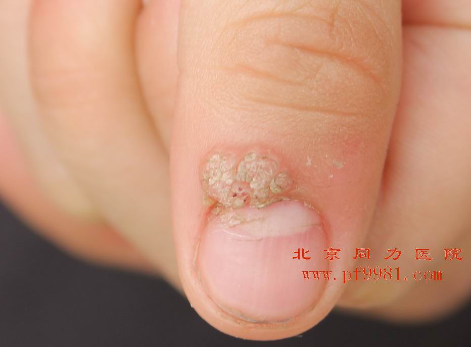  p>鱼痣即鱼鳞痣,究其本质不是一种痣,其实是一种 a target="_blank"