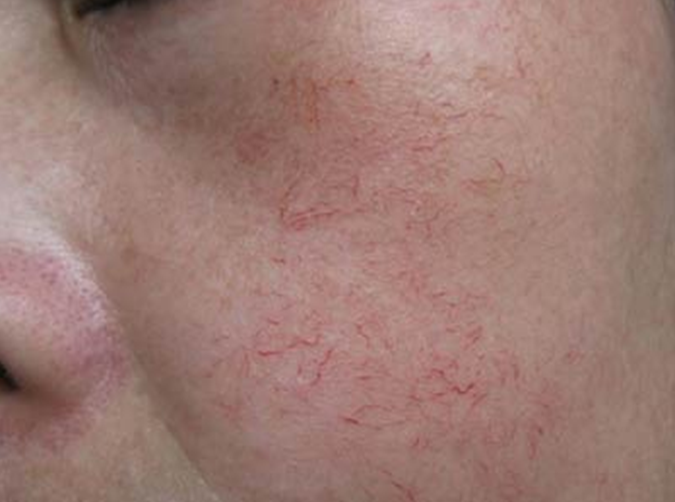 data-lemmaid="8849994">肉眼 /a>就能看见一条条扩张的毛细血管,部分