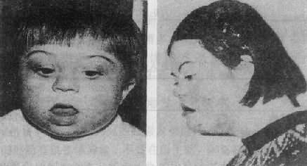 爱德华氏综合症