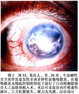 arthritis)是一种血清阴性(即血清类风湿因子阴性)的关节炎,典型地